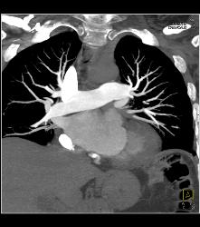 Perfectly Timed Pulmonary Embolism (PE) Study Although Contrast Is Still Being Injected- Less Contrast Can Be Used With Fast Scanning - CTisus CT Scan