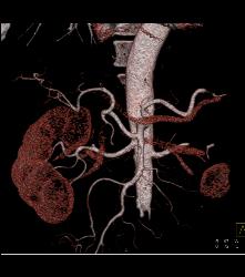 Hepatic Artery Arises Off SMA - CTisus CT Scan