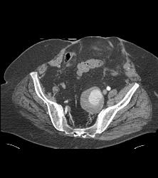 Internal Iliac Artery Aneurysm - CTisus CT Scan