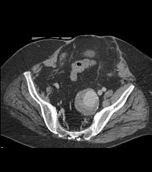 Internal Iliac Artery Aneurysm - CTisus CT Scan