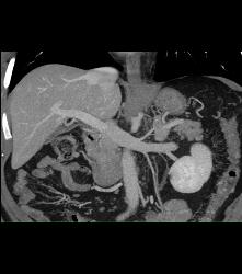 Left Adrenal and Gonadal Defined - CTisus CT Scan