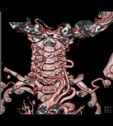 Tortuous Artery Syndrome - CTisus CT Scan