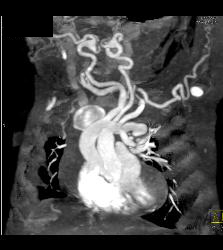 Tortuous Artery Syndrome - CTisus CT Scan