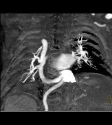 Tortuous Artery Syndrome - CTisus CT Scan