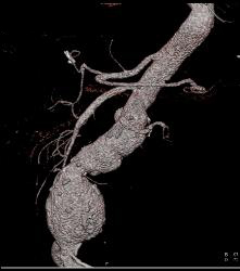 Abdominal Aortic Aneurysm (AAA) With Edited Views - CTisus CT Scan