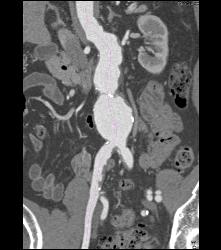 Abdominal Aortic Aneurysm (AAA) With Edited Views - CTisus CT Scan