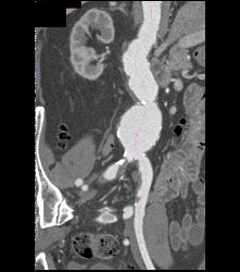 Abdominal Aortic Aneurysm (AAA) With Edited Views - CTisus CT Scan