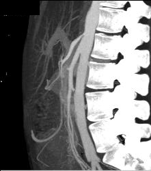 Superior Mesenteric Artery (SMA) Syndrome - CTisus CT Scan