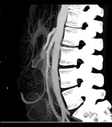 Superior Mesenteric Artery (SMA) Syndrome - CTisus CT Scan