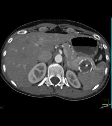 Splenic Artery Aneurysm - CTisus CT Scan