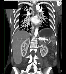 Splenic Artery Aneurysm - CTisus CT Scan