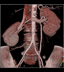 Prominent Left Gonadal Vein - CTisus CT Scan