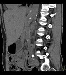 Mesenteric Bypass Graft With Stenosis- See Sequence- At Anastomosis to SMA - CTisus CT Scan