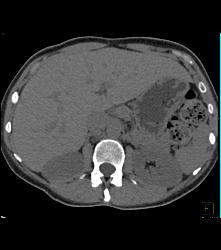 Mesenteric Bypass Graft With Stenosis- See Sequence- At Anastomosis to SMA - CTisus CT Scan