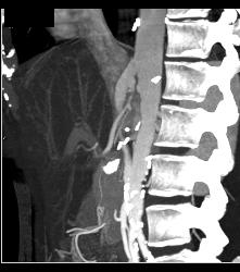 Mesenteric Bypass Graft With Stenosis- See Sequence- At Anastomosis to SMA - CTisus CT Scan