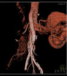 Mesenteric Bypass Graft With Stenosis- See Sequence- At Anastomosis to SMA - CTisus CT Scan