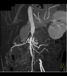 Mesenteric Bypass Graft With Stenosis- See Sequence- At Anastomosis to SMA - CTisus CT Scan