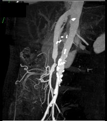 Mesenteric Bypass Graft With Stenosis- See Sequence- At Anastomosis to SMA - CTisus CT Scan