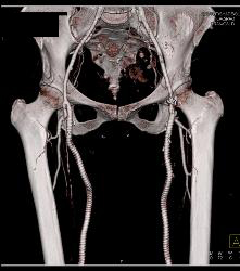 Runoff Study for Vascular Stents- Full Sequence and ??? - CTisus CT Scan