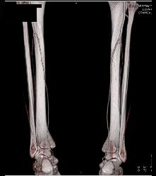 Runoff Study for Vascular Stents- Full Sequence and ??? - CTisus CT Scan
