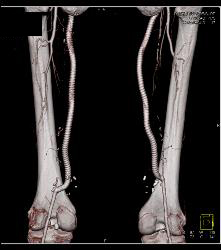 Sgap Planning - CTisus CT Scan