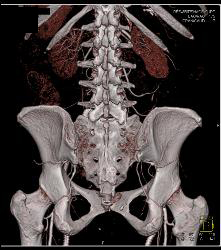 Sgap Planning - CTisus CT Scan