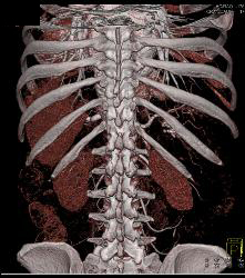 Runoff Study for Vascular Stents- Full Sequence and ??? - CTisus CT Scan