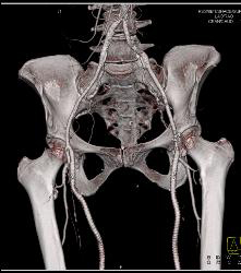 Runoff Study for Vascular Stents- Full Sequence and ??? - CTisus CT Scan