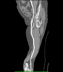 Runoff Study for Vascular Stents- Full Sequence and ??? - CTisus CT Scan