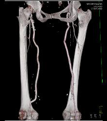 Runoff Study for Vascular Stents- Full Sequence and ??? - CTisus CT Scan