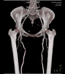 Runoff Study for Vascular Stents- Full Sequence and ??? - CTisus CT Scan