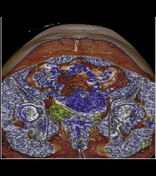 DIEP Flap Planning - CTisus CT Scan