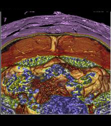 DIEP Flap Planning - CTisus CT Scan