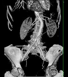 Spinal Surgery With Screw Abutting the Aorta - CTisus CT Scan