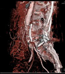 Spinal Surgery With Screw Abutting the Aorta - CTisus CT Scan