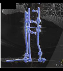 Spinal Surgery With Screw Abutting the Aorta - CTisus CT Scan