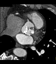 Extensive Aortic Valve Calcification and Aortic Stenosis - CTisus CT Scan