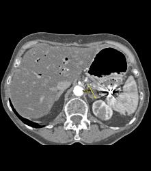 Splenic Artery Aneurysm Embolized - CTisus CT Scan