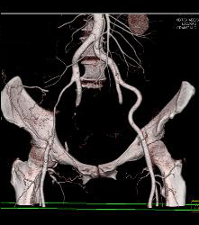 Near Occlusion of Right External Iliac Artery- See Full Sequence - CTisus CT Scan