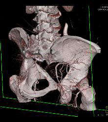 Near Occlusion of Right External Iliac Artery- See Full Sequence - CTisus CT Scan