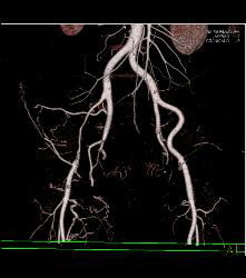 Near Occlusion of Right External Iliac Artery- See Full Sequence - CTisus CT Scan