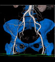 Near Occlusion of Right External Iliac Artery- See Full Sequence - CTisus CT Scan