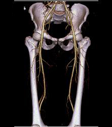 Near Occlusion of Right External Iliac Artery- See Full Sequence - CTisus CT Scan