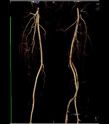 GSW Thigh - CTisus CT Scan