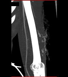 GSW Elbow - CTisus CT Scan