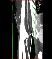 Superior Mesenteric Artery (SMA) Syndrome - CTisus CT Scan