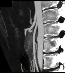 Superior Mesenteric Artery (SMA) Syndrome - CTisus CT Scan