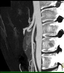 Superior Mesenteric Artery (SMA) Syndrome - CTisus CT Scan