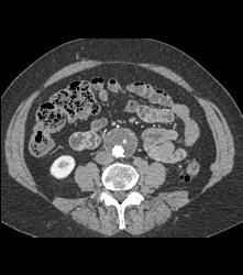 Aortic Aneurysm Repair With Stents Plus Fem-fem Bypass - CTisus CT Scan