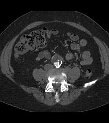 Aortic Aneurysm Repair With Stents Plus Fem-fem Bypass - CTisus CT Scan